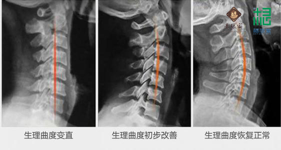 非遗老张家膏贴：颈椎反弓是颈椎病吗？